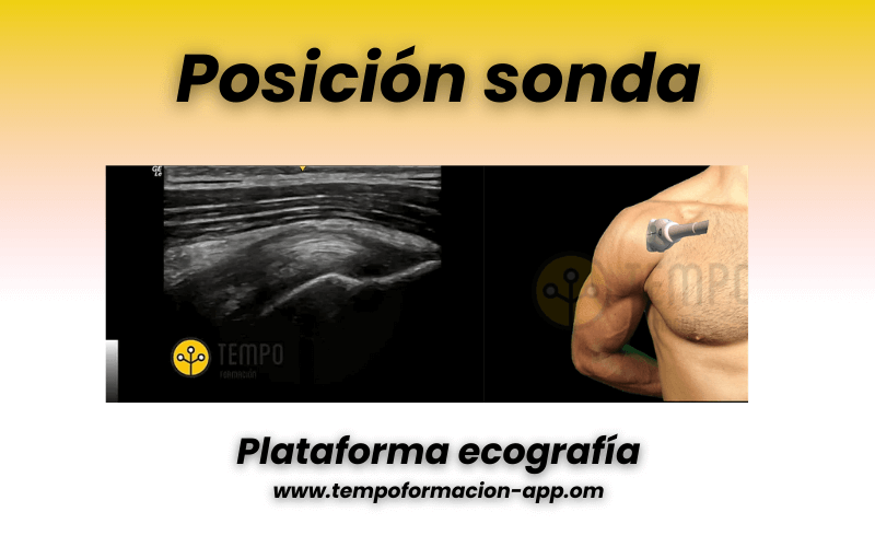 1. Tendon supraespinoso ecografia y patologia.png